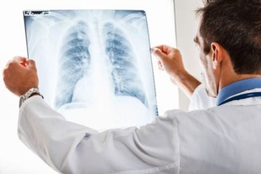 Τι επιπτώσεις προκαλεί ο κορονοϊός στους πνεύμονες;